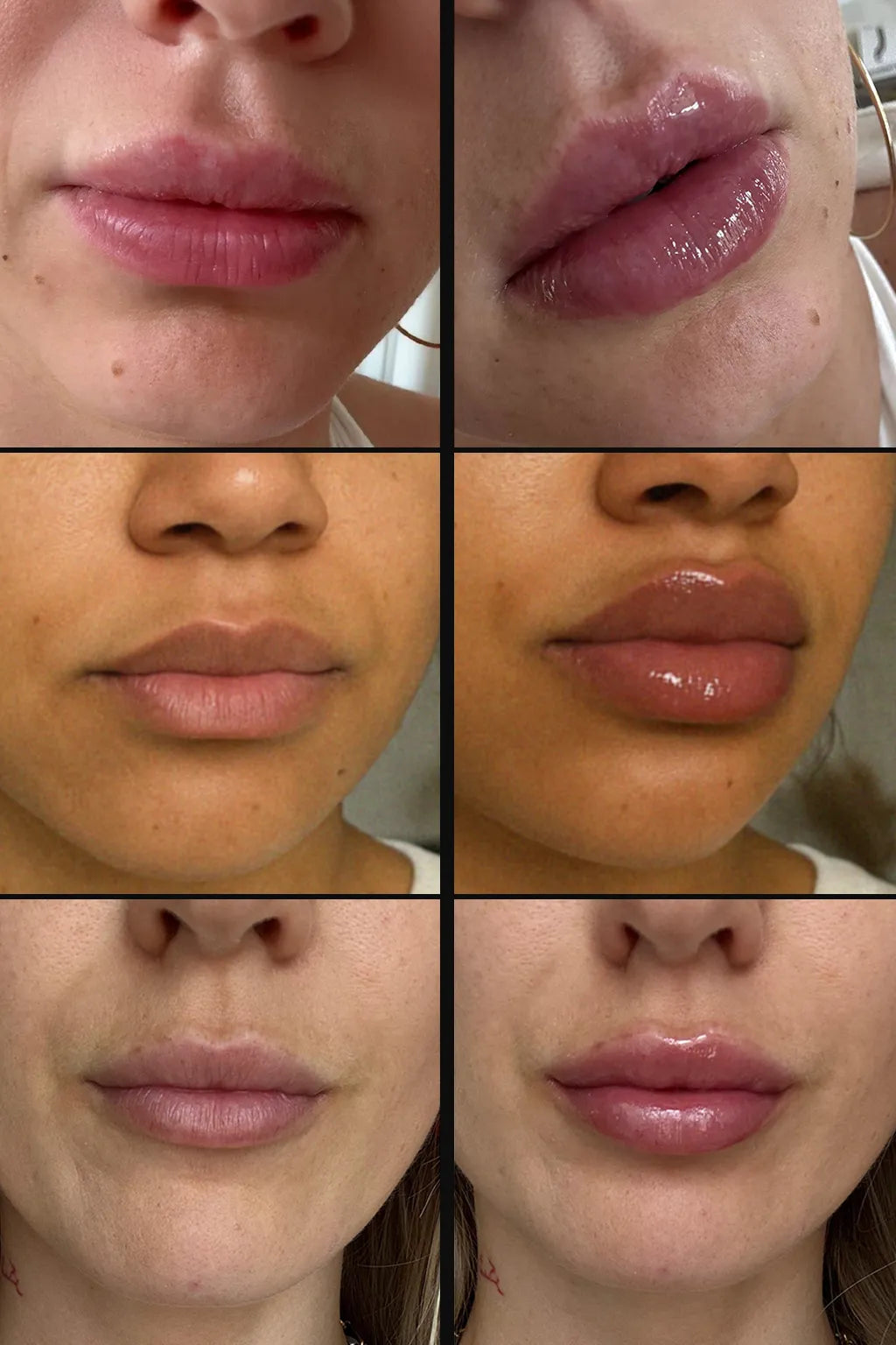 Avant/Après application du gloss repulpant lèvres Nemesys
