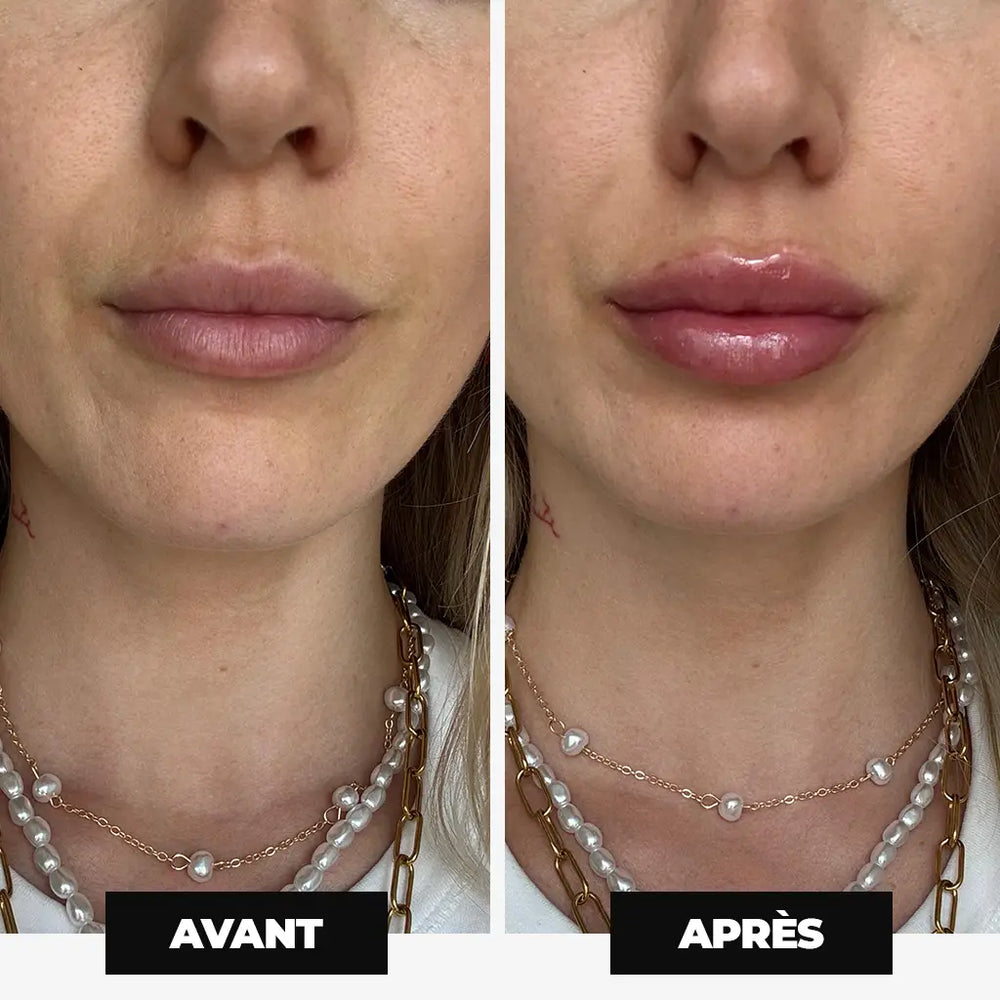 Résultat avant après gloss repulpant — volume lèvres visible, cliente NEMESYS™ Volcano Kiss